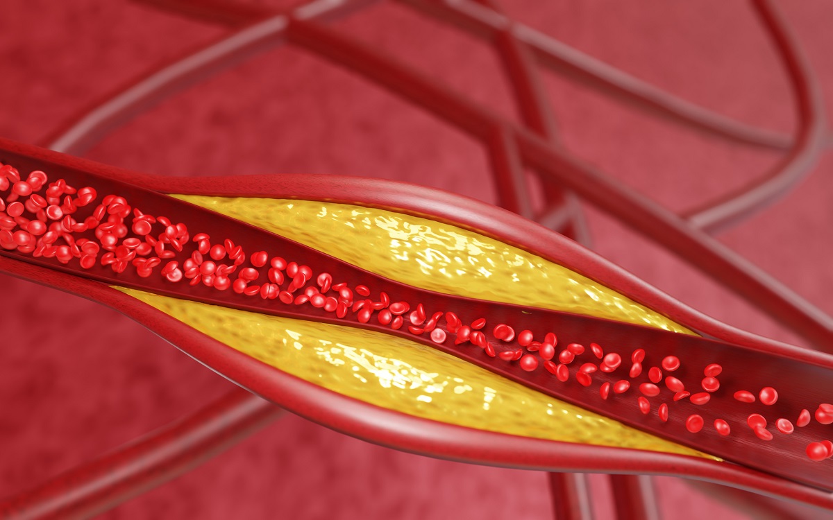 Carotid Artery Disease