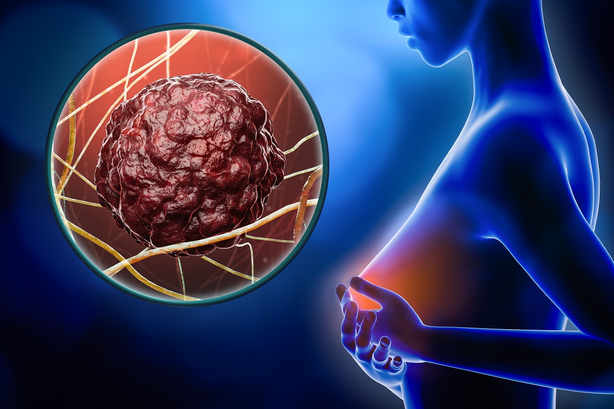 Breast Cancer: Symptoms and Risk Factors