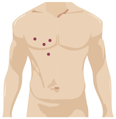 Robotic Surgery Incision