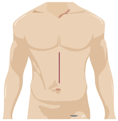 Traditional Surgery Location for colorectal surgery