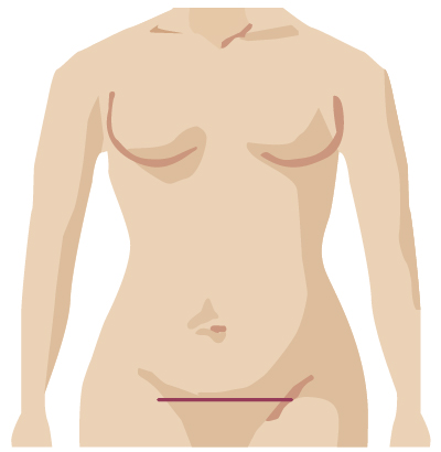 Traditional surgery incision from urogynecologic surgery