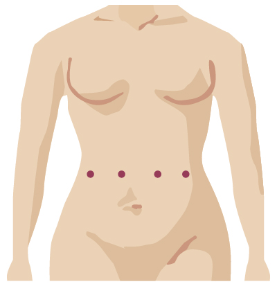 Robotic surgery incision from gyn onc surgery