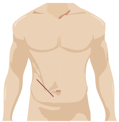 Traditional surgery incision for hernia