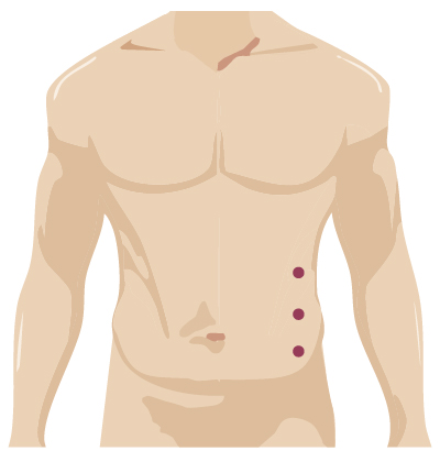 Robotic surgery incision for general surgery